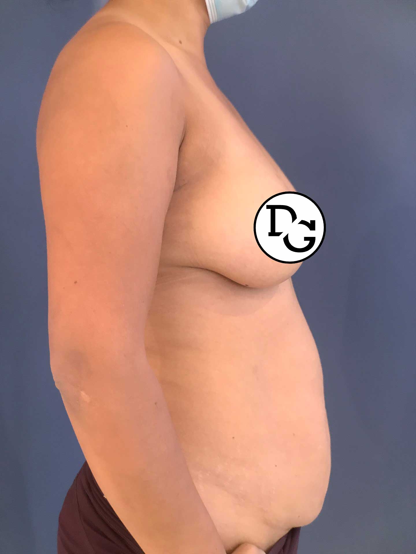 Consult-Breast,-Abdomen-copy-n