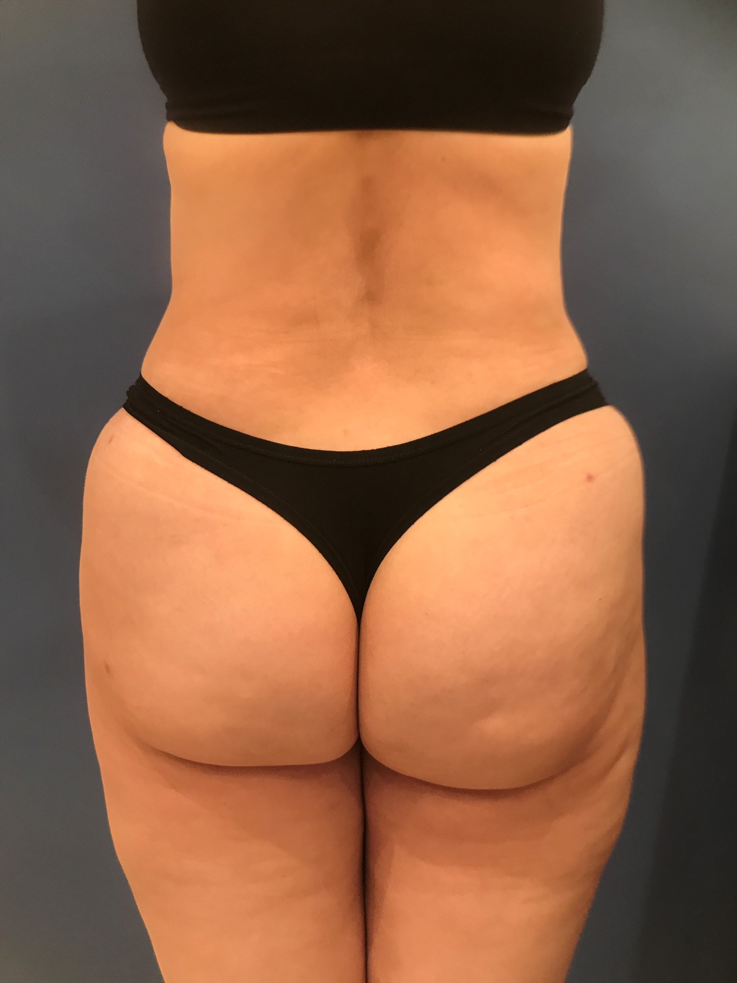 8 Wks Post Surgery copy 5