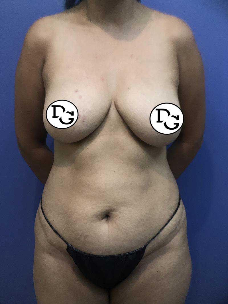 Preop-Breast-Augmentation-And-Abdominoplasty-3