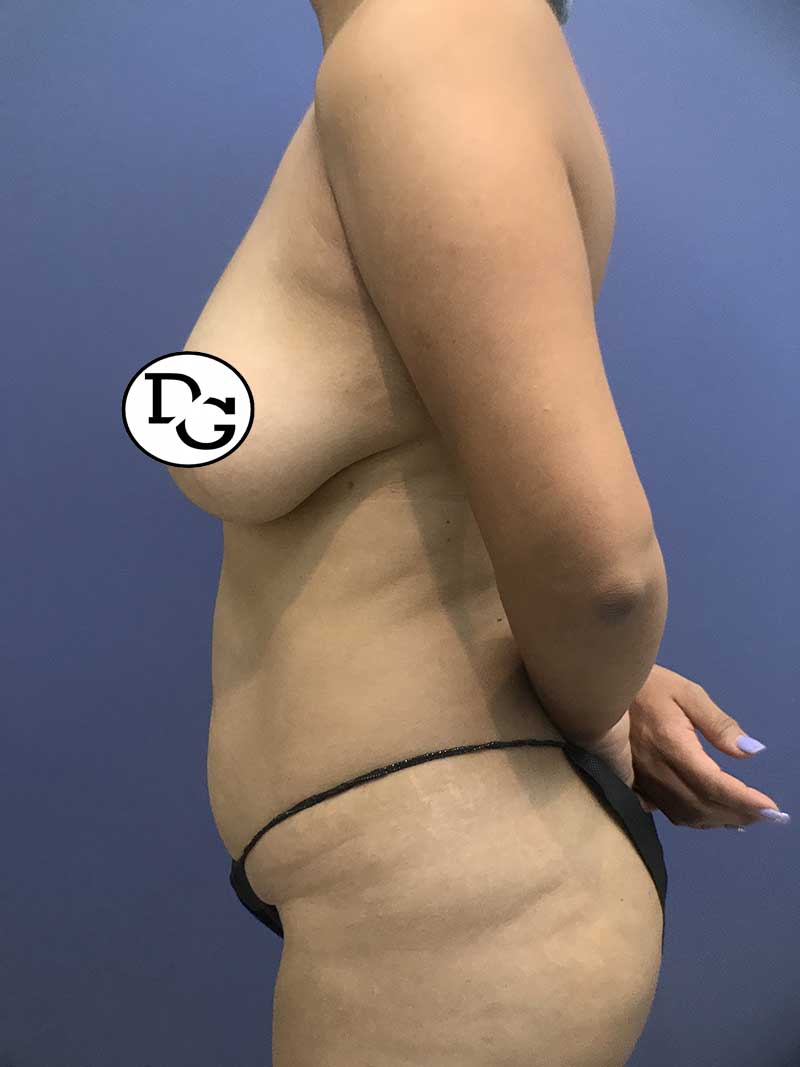 Preop-Breast-Augmentation-And-Abdominoplasty-4