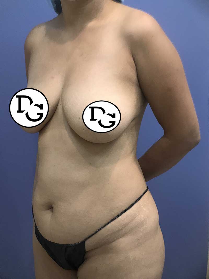 Preop-Breast-Augmentation-And-Abdominoplasty-5