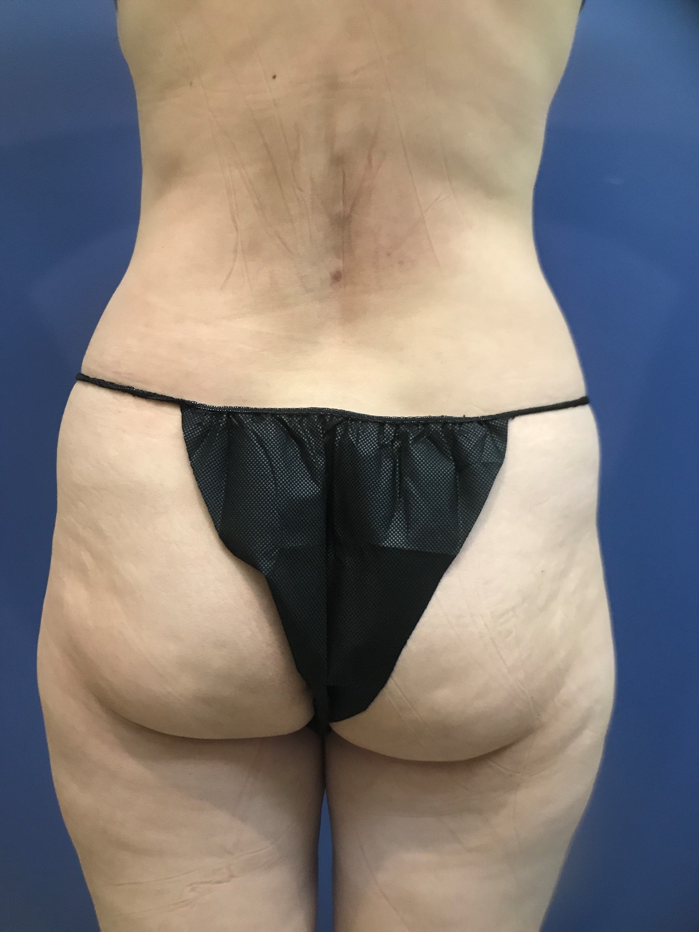 Preop Lipo 360 , BBl copy 5